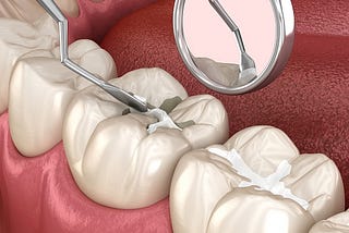 What are dental sealants? Are they safe?