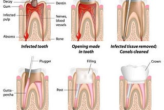 Proven Research That Show How Root Canal Treatment Can Fix Teeth Pain