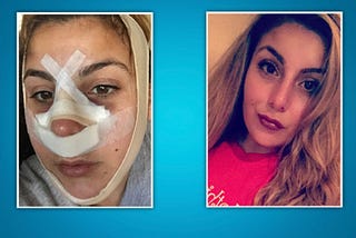 Nose Plastic Surgery and Selfie