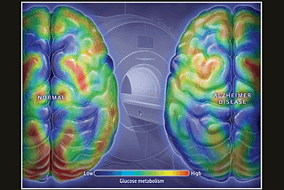 Alzheimer’s disease and glucose metabolism