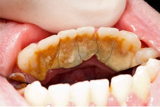 Sensitive gums and teeth