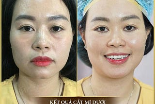 Dịch vụ cắt mí dưới tại Dr. Hải Lê có tốt không?