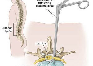 Bid Farewell to your back pain with Endoscopic Discectomy