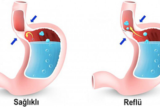 GASTROÖZOFAGEAL REFLÜDE BESLENME TEDAVİSİ