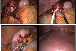 Acute Appendicitis with Pyogenic Liver Abscesses