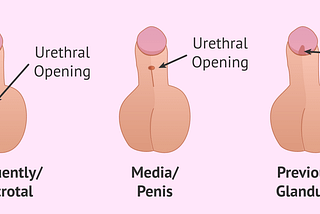 What Caused My Child’s hypospadias and What Can Be Done?