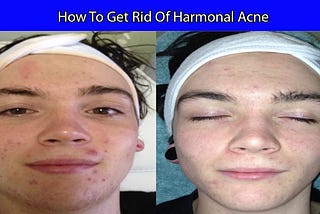 FtM Dealing with Acne & Other Skin Breakouts F2M