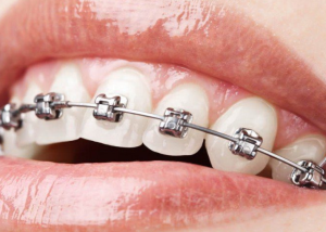 STRAIGHTEN YOUR SMILE AT ANY AGE: ORTHODONTIC TREATMENTS FOR ADULTS