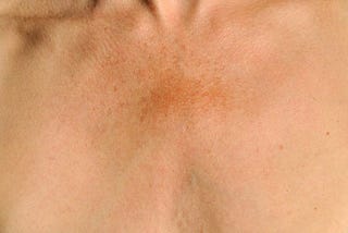 Melasma