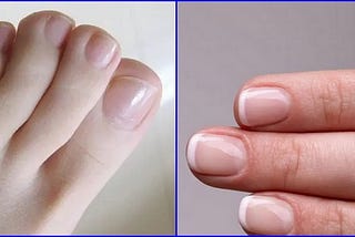 Cómo Curar Los Hongos de las Uñas Rápidamente 100% Natural