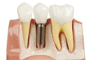5 Advantages of Dental Implants in Sherman Oaks Over Dentures