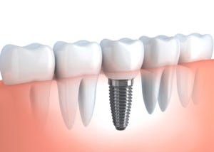 Thời điểm cấy ghép Implant cho người mới nhổ răng