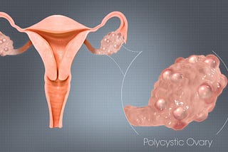 PCOS: A Mysterious Disorder