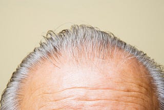 Can Adderall Indirectly Cause Hair Loss?