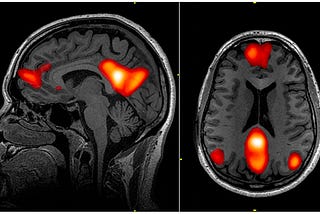 Default Mode Network and Sports