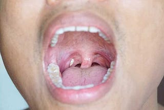 Awkward Problem: Does Smoking Cause Tonsil Stones?