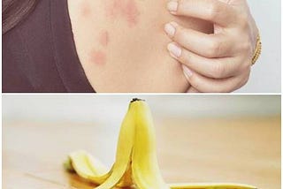 12 DIY Home Remedies For Bug Bites — DIY Bug Bites Home Remedy!