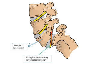 Spondylosis