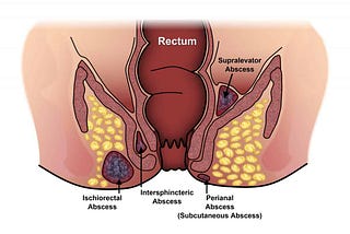 Karanool Therapy in Siddha for Fistula-in-ano Treatment