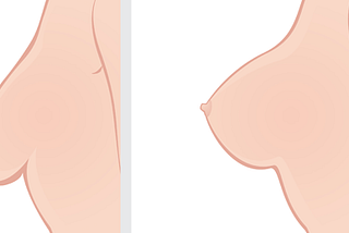 What is Breast Uplift — Mastopexy?