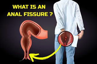 Understanding Anal Fissures: Causes, Symptoms, and Treatment