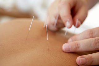 Yes Acupuncture Can Heal Your Whole Body.