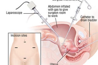 A Laparascopic Hysterectomy isn’t as scary as it sounds