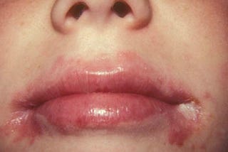 Is Angular Cheilitis Serious? How to Get Rid of It ?