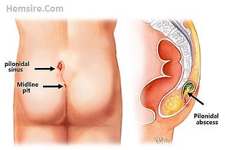 Kıl Dönmesi (Pilonidal Sinüs) Nedenleri, Tedavisi ve Ameliyatı