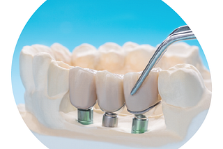best dental implant in bangaloreBeyond Smiles : Best Dental Implants In Bangalore