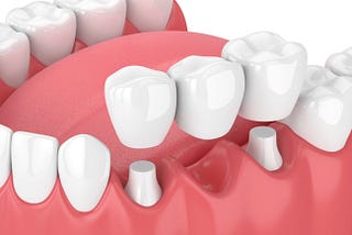 Common Problems with Crowns and Bridges and How to Fix Them