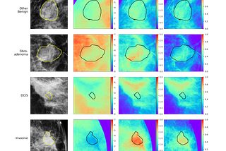 Compositional heat map for cancerous and non-cancerous breast lesion types. Redder colors indicate thicker regions while bluer regions represent thinner or no thickness.