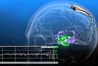 NeuroPace- The Device That Stops Seizures Before They Happen