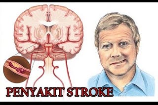 Obat Stroke Sebelah Kanan