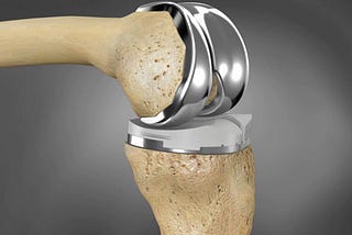 Persisting Pain After Knee Replacement