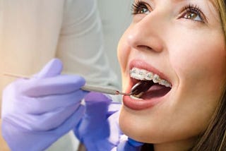 What You Need To Know About Getting Braces as an Adult