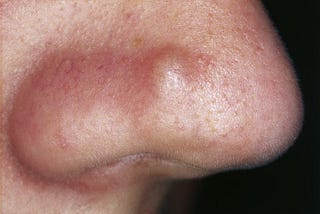 Fibrous papule of the nose: [Complete Information] — Health Salubrity — Health Salubrity