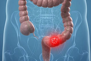 COLORECTAL CANCER IN PEOPLE OF EUROPEAN AND AFRICAN DESCENT EXPLAINED