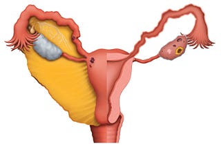 Endometriosis Staging — The Four Stages of Endometriosis