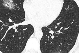 Computed Tomography (CT) Diagnosis of COVID-19 using Supervised Learning