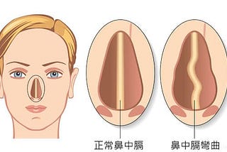 鼻中隔彎曲開刀經驗