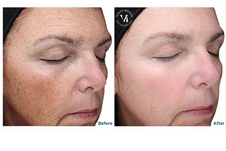 5 Amazing Benefits of VI Peel Precision Plus | Prescott Medical Aesthetics