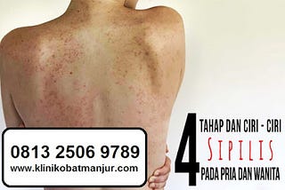 cara cepat mengobati penyakit sipilis