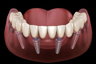 The Lifelong Benefits of All-on-4 Dental Implants