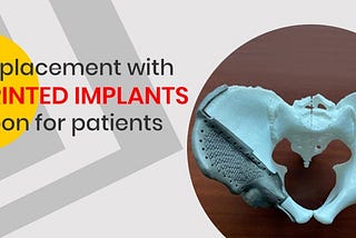 Hip replacement with 3D printed implants — A boon for patients — 3DIncredible