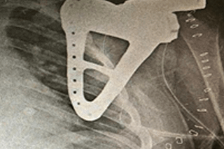 Use of 3D printed customized implant for scapula reconstruction in total scapulectomy surgery for…