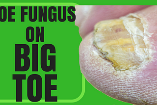 Toenail Fungus on Big Toe