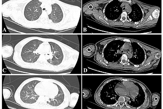 The Challenge Management of a Child with Cervical Spinal Cord Injury with Ultrasound Assessment of…