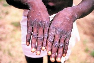 Monkey Pox — a blog by Dr. Dangs Lab