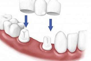 Các bước thực hiện dịch vụ bọc răng sứ thẩm mỹ nha khoa